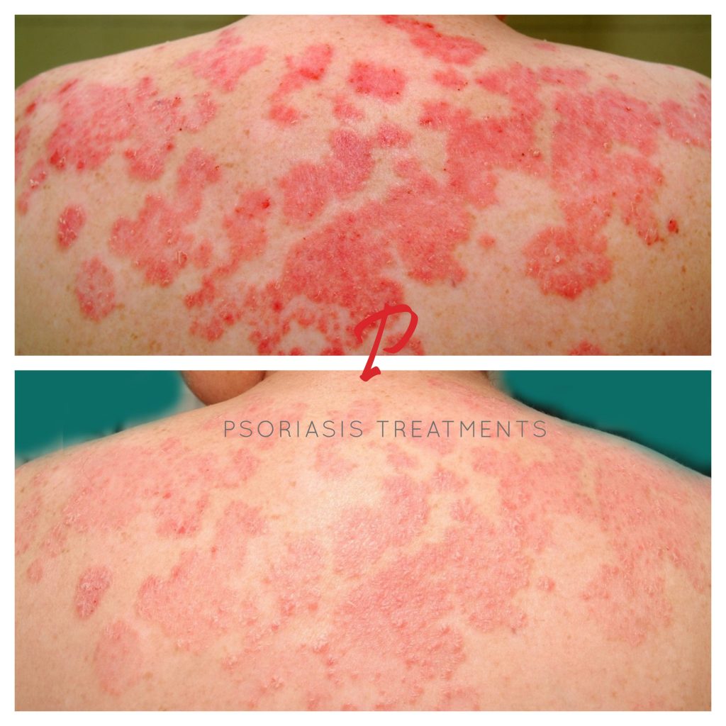 Unique Natural Psoriasis Treatment