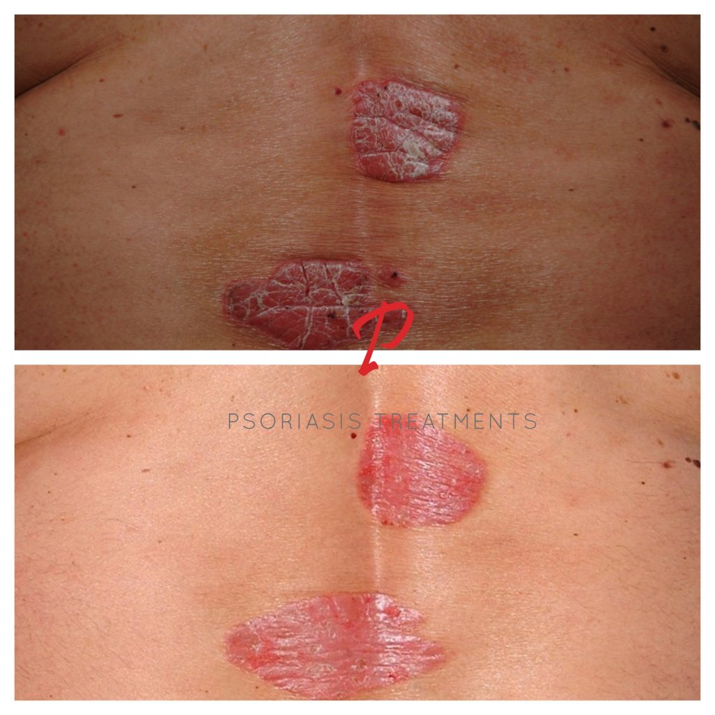14 Before & After