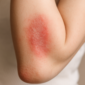 Psoriasistreatments.net Close-up of red, inflamed eczema rash on the inner forearm with dry, itchy skin.