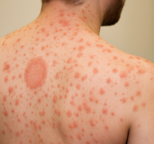 Oval-shaped herald patch and smaller scaly lesions on a person’s back, characteristic of pityriasis rosea.