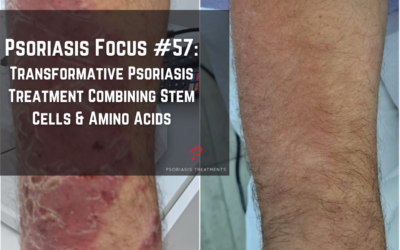 Transformative Psoriasis Treatment: A Patient’s Journey with Stem Cells and Amino Acid Infusions