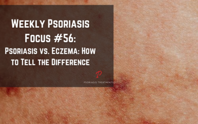 Psoriasis vs. Eczema: How to Tell the Difference