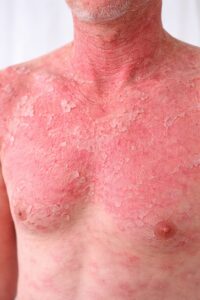 Widespread red inflamed skin with extensive scaling