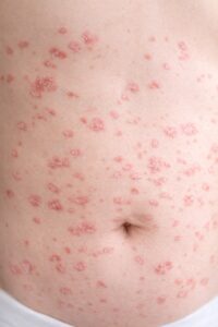Guttate psoriasis with small red drop-shaped lesions scattered across the skin