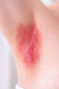 Inverse psoriasis presenting as smooth red inflamed patches in skin folds
