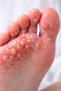 Pustular psoriasis with clusters of white pustules on inflamed skin